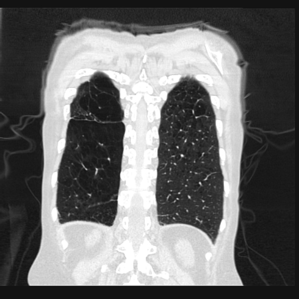 Centrilobular pulmonary emphysema (Radiopaedia 24495-24789 Coronal lung window 65).jpg