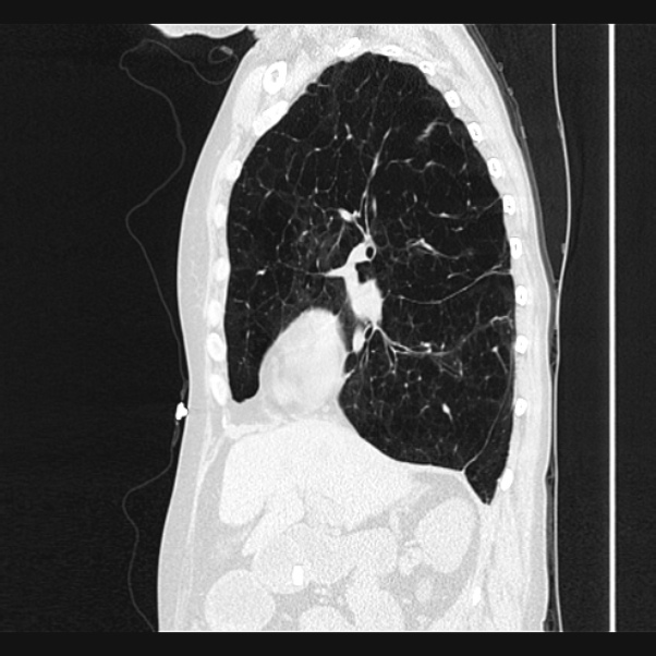 Centrilobular pulmonary emphysema (Radiopaedia 24495-24789 Sagittal lung window 31).jpg