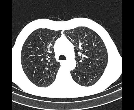 Centrilobular pulmonary emphysema (Radiopaedia 62468-70718 Axial lung window 26).jpg