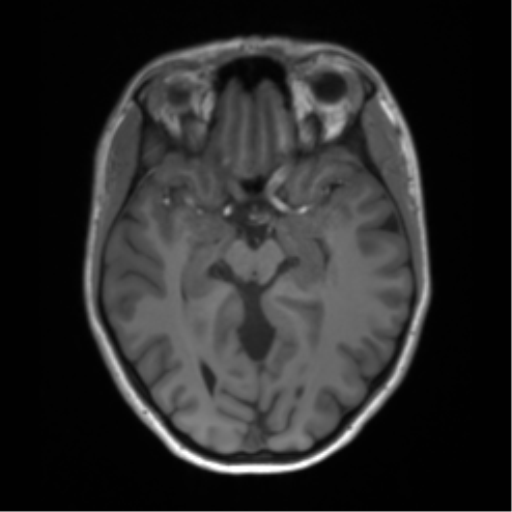 Cerebellar agenesis with hypoplastic pons (pontocerebellar hypoplasia) (Radiopaedia 57224-64138 Axial T1 33).png