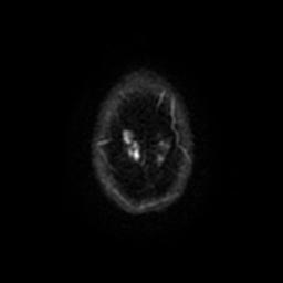 Cerebellar hemangioblastoma (Radiopaedia 29570-30077 Axial DWI 52).jpg