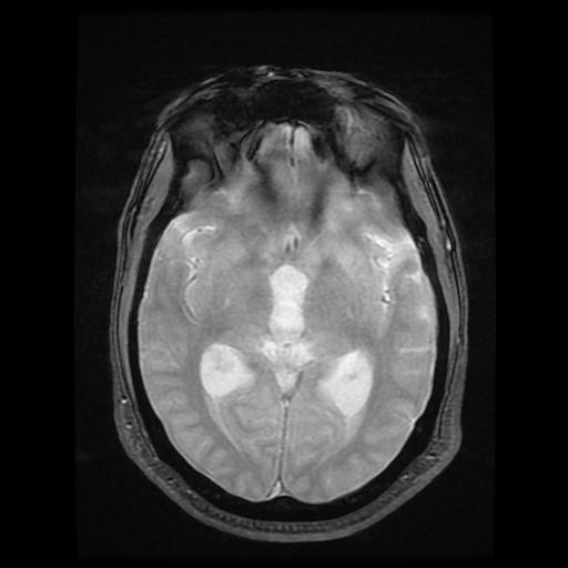 File:Cerebellar hemangioblastoma (Radiopaedia 88055-104622 Axial Gradient Echo 10).jpg