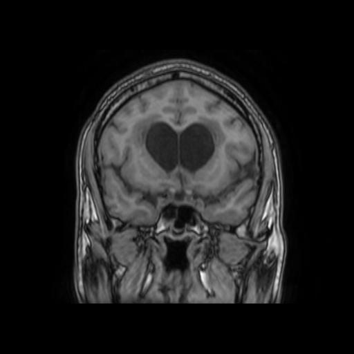 File:Cerebellar hemangioblastoma (Radiopaedia 88055-104622 Coronal T1 14).jpg