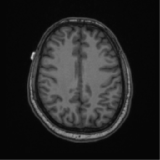 Cerebellar hemangioblastomas and pituitary adenoma (Radiopaedia 85490-101176 Axial T1 51).png