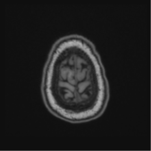File:Cerebellar hemangioblastomas and pituitary adenoma (Radiopaedia 85490-101176 Axial T1 67).png