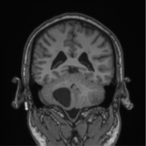 Cerebellar hemangioblastomas and pituitary adenoma (Radiopaedia 85490-101176 Coronal T1 36).png