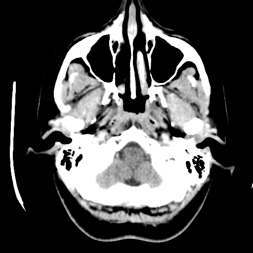 Cerebellar metastasis (cystic appearance) (Radiopaedia 41395-44258 B 7).png