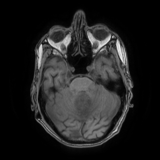 File:Cerebellar metastasis - lung tumor (Radiopaedia 69317-79147 Axial T1 13).jpg