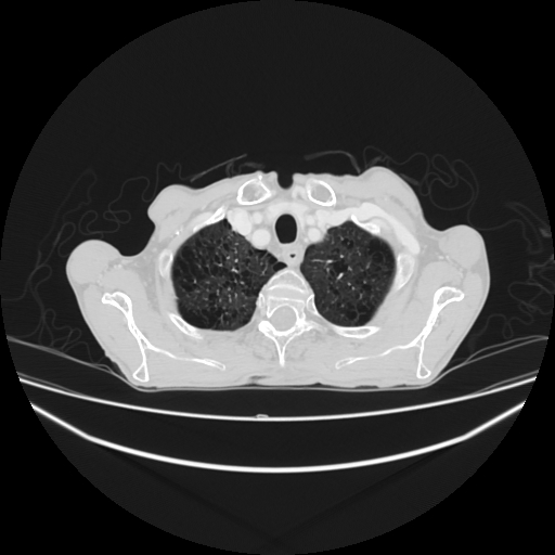 File:Cerebellar metastasis - lung tumor (Radiopaedia 69317-79150 Axial lung window 4).jpg