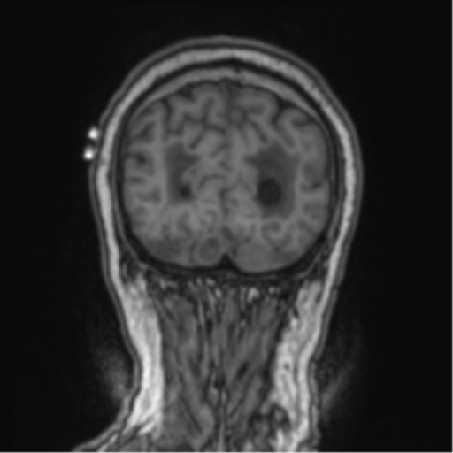 Cerebellar metastasis from lung adenocarcinoma (Radiopaedia 86690-102829 Coronal T1 16).png