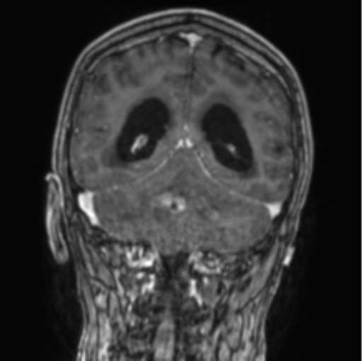 Cerebellar metastasis from lung adenocarcinoma (Radiopaedia 86690-102829 Coronal T1 C+ 36).png