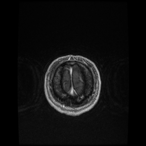 Cerebellar metastasis of pulmonary adenocarcinoma, cavernous venous malformation, and developmental venous anomaly (Radiopaedia 85827-101661 Axial T1 C+ 85).jpg