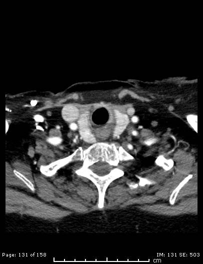 File:Cerebellar strokes due to intracranial giant cell arteritis (Radiopaedia 68799-78510 CT angiogram 131).jpg