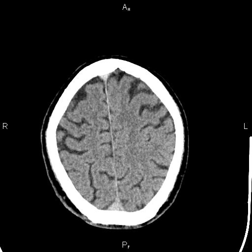 Cerebellopontine angle arachnoid cyst (Radiopaedia 85149-100704 Axial With contrast 41).jpg