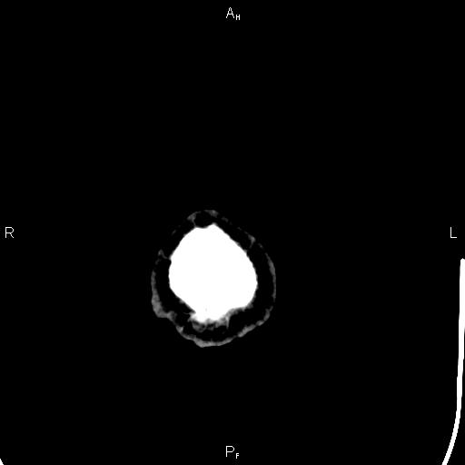 Cerebellopontine angle arachnoid cyst (Radiopaedia 85149-100704 Axial With contrast 56).jpg
