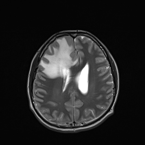 Cerebral abscess (Radiopaedia 24212-24478 Axial T2 41).jpg