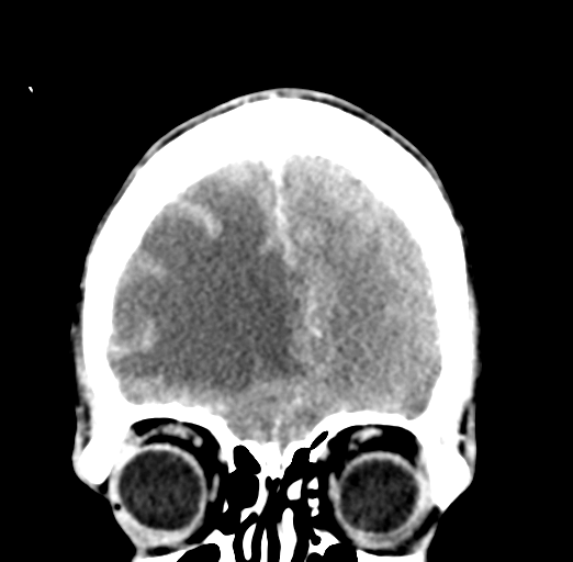 Cerebral abscess (Radiopaedia 60342-68008 Coronal C+ delayed 14).png
