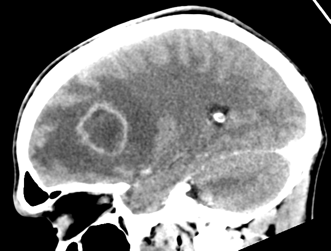 File:Cerebral abscess (Radiopaedia 60342-68008 Sagittal C+ delayed 33).png