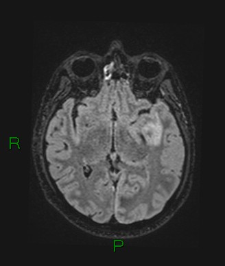 File:Cerebral abscess and subdural empyema (Radiopaedia 84436-99779 Axial FLAIR 47).jpg