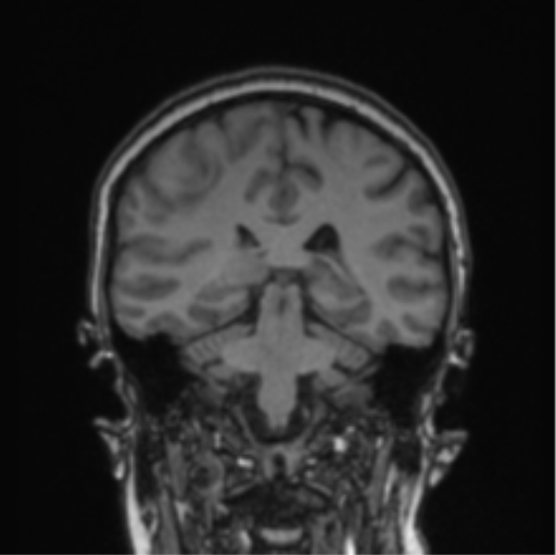 Cerebral abscess from pulmonary arteriovenous malformation (Radiopaedia 86275-102291 Coronal T1 38).png