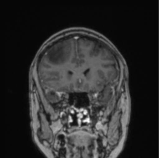 Cerebral abscess from pulmonary arteriovenous malformation (Radiopaedia 86275-102291 L 63).png