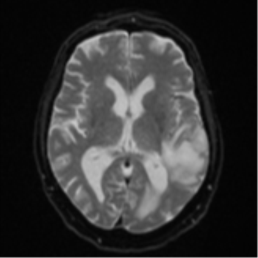 Cerebral abscesses- medically managed (Radiopaedia 45183-49179 Axial DWI 15).png