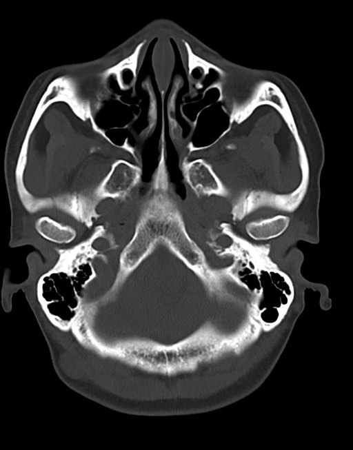 Cerebral abscesses (Radiopaedia 70458-80568 Axial bone window 14).jpg