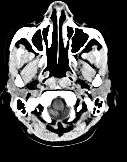 Cerebral abscesses (Radiopaedia 70458-80568 Axial non-contrast 11).jpg