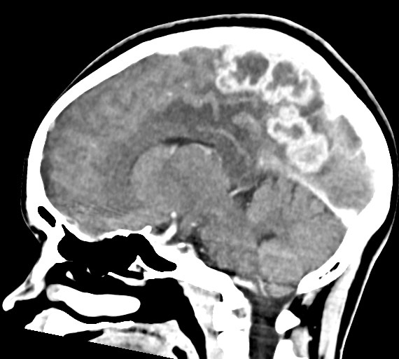 Cerebral abscesses (Radiopaedia 70458-80568 Sagittal Contrast 27).jpg