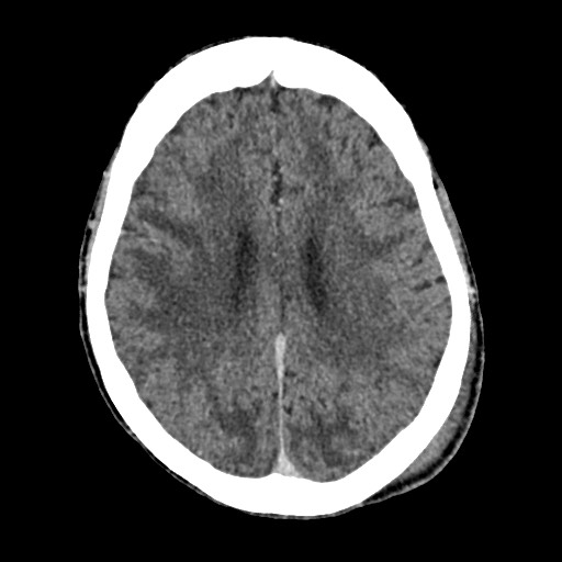 Cerebral amyloid angiopathy-related inflammation (Radiopaedia 74836-85848 Axial non-contrast 40).jpg