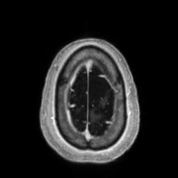 Cerebral amyloid angiopathy (Radiopaedia 29129-29518 Axial T1 C+ 137).jpg