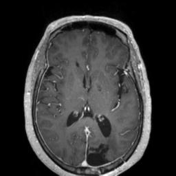 File:Cerebral amyloid angiopathy (Radiopaedia 29129-29518 Axial T1 C+ 80).jpg
