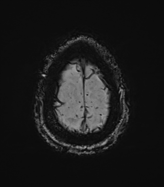 Cerebral amyloid angiopathy (Radiopaedia 46082-50433 Axial SWI 80).png