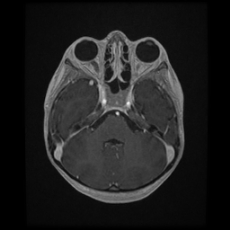 Cerebral and spinal tuberculosis (Radiopaedia 90489-107837 Axial T1 C+ 63).jpg