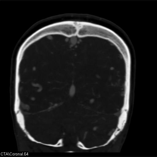 Cerebral arteriovenous malformation (Radiopaedia 28518-28759 C 64).jpg