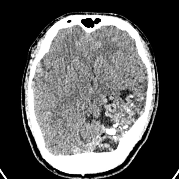 Cerebral arteriovenous malformation (Radiopaedia 37182-39012 Axial non-contrast 22).jpg