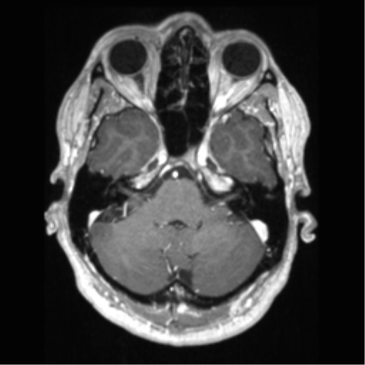 File:Cerebral arteriovenous malformation (Radiopaedia 39259-41506 AX T1 MPR C+ 16).png