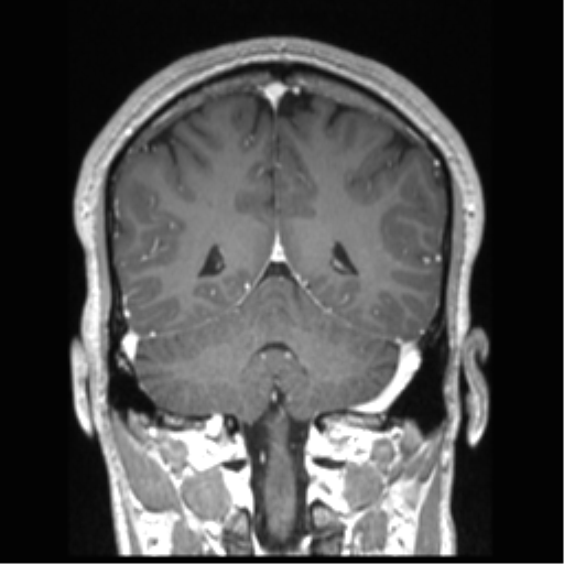 Cerebral arteriovenous malformation (Radiopaedia 39259-41506 Coronal T1 C+ 32).png