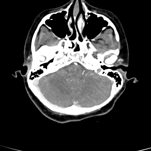 Cerebral arteriovenous malformation (Radiopaedia 73830-84645 B 79).jpg