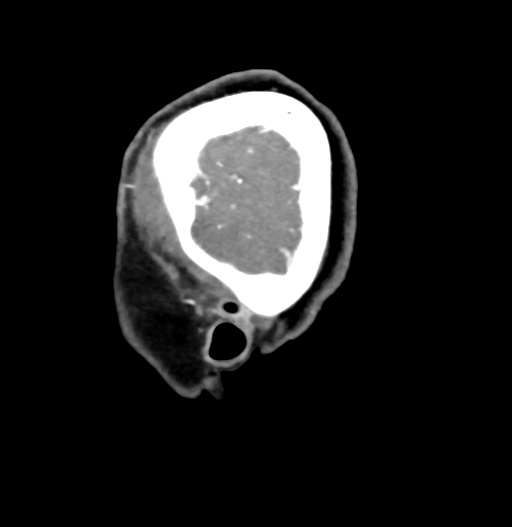 Cerebral arteriovenous malformation (Radiopaedia 73830-84645 D 7).jpg