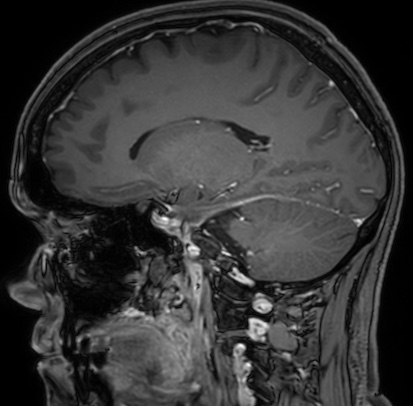 Cerebral arteriovenous malformation (Radiopaedia 74411-85654 Sagittal T1 C+ 52).jpg