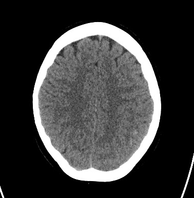 File:Cerebral arteriovenous malformation (Radiopaedia 74411-85744 Axial non-contrast 25).jpg