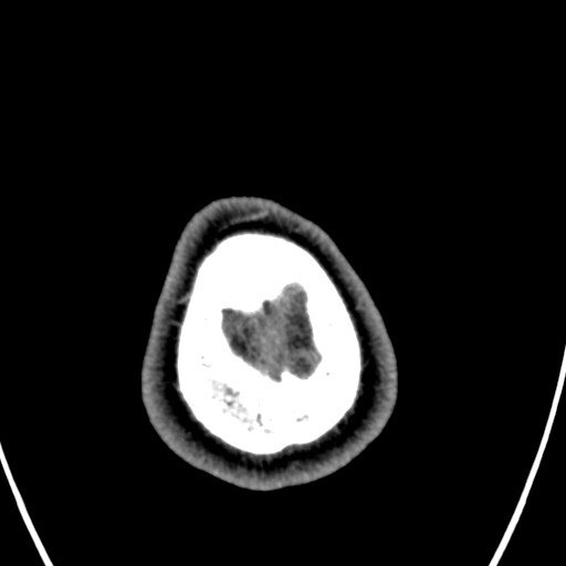 Cerebral arteriovenous malformation (Radiopaedia 78188-90746 Axial C+ delayed 168).jpg