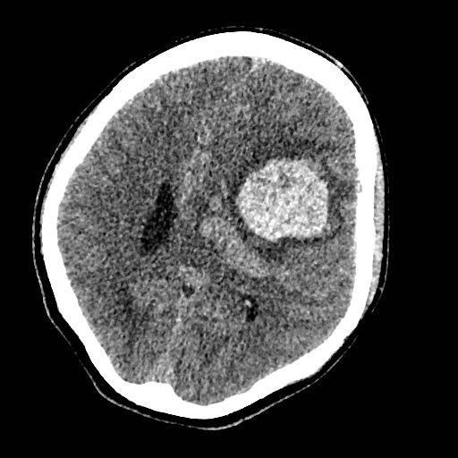 Cerebral arteriovenous malformation (Radiopaedia 79677-92887 Axial non-contrast 24).jpg