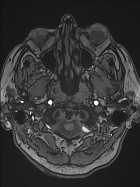 Cerebral arteriovenous malformation (Radiopaedia 84015-99245 Axial TOF 43).jpg