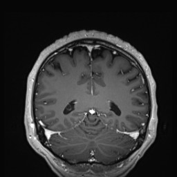 Cerebral arteriovenous malformation (Radiopaedia 84015-99245 Coronal T1 C+ 118).jpg