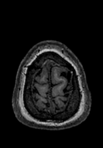 Cerebral arteriovenous malformation at posterior body of corpus callosum (Radiopaedia 74111-84925 Axial T1 6).jpg