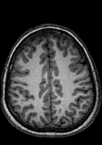 Cerebral arteriovenous malformation at posterior body of corpus callosum (Radiopaedia 74111-84925 Axial T1 74).jpg