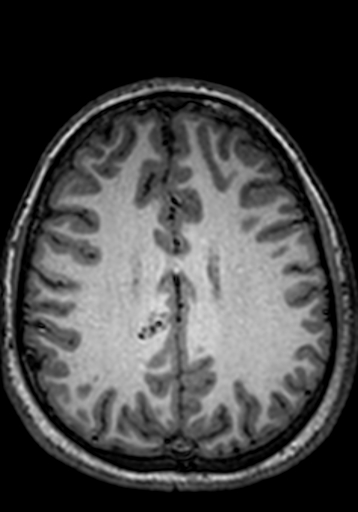 Cerebral arteriovenous malformation at posterior body of corpus callosum (Radiopaedia 74111-84925 Axial T1 92).jpg