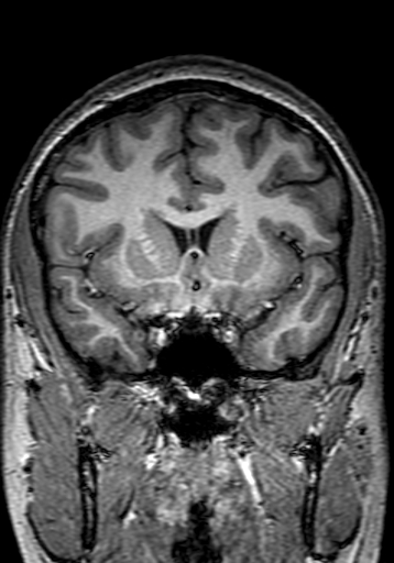 File:Cerebral arteriovenous malformation at posterior body of corpus callosum (Radiopaedia 74111-84925 Coronal T1 112).jpg